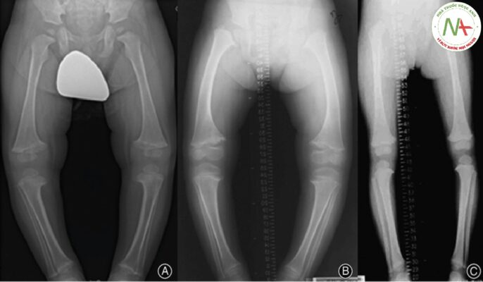 Loạn sản sụn hành xương (METAPHYSEAL CHONDRODYSPLASIA)