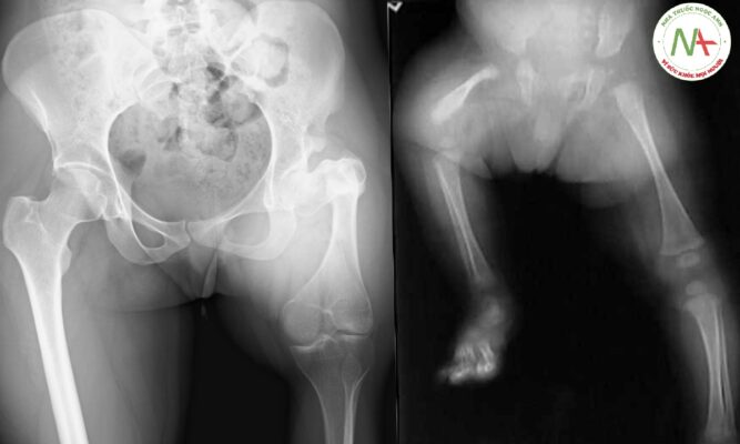 Loạn sản xương đùi khu trú đoạn gần (PROXIMAL FOCAL FEMORAL DYSPLASIA)