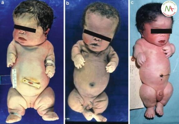 Loạn sản xương gây chết (THANATOPHORIC DYSPLASIA)