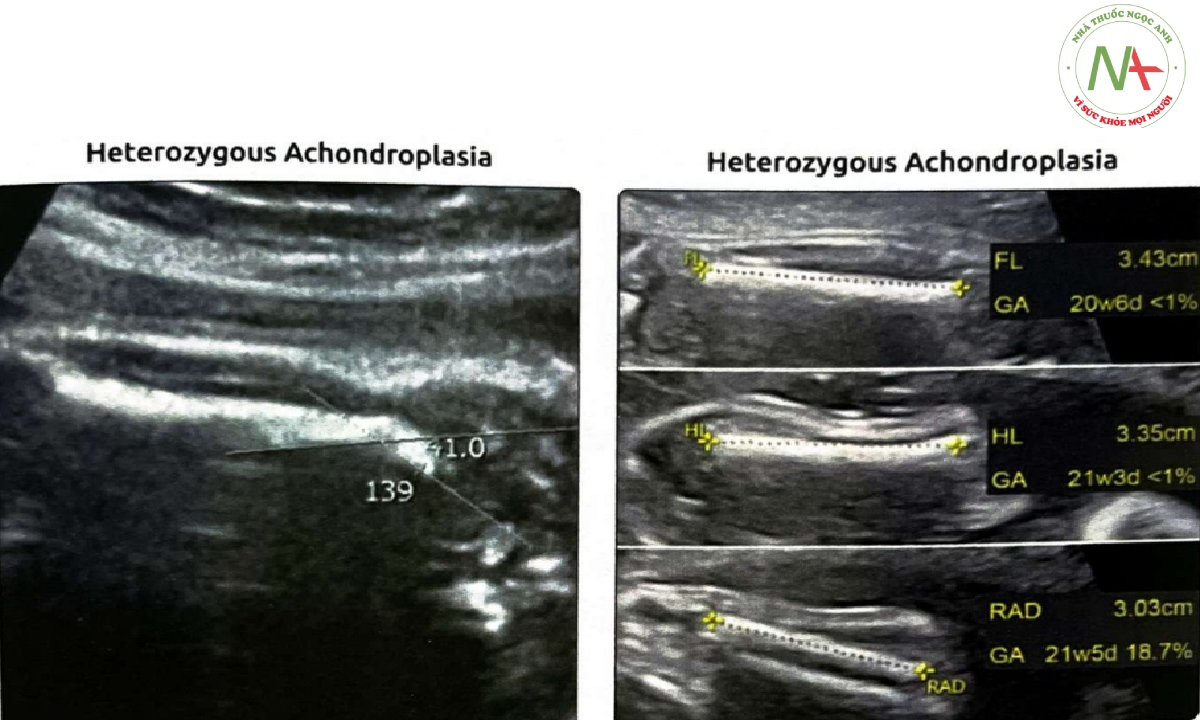 Mở rộng góc thân xương-hành xương đùi đoạn gần (diaphysis-metaphysis angle (DMA))