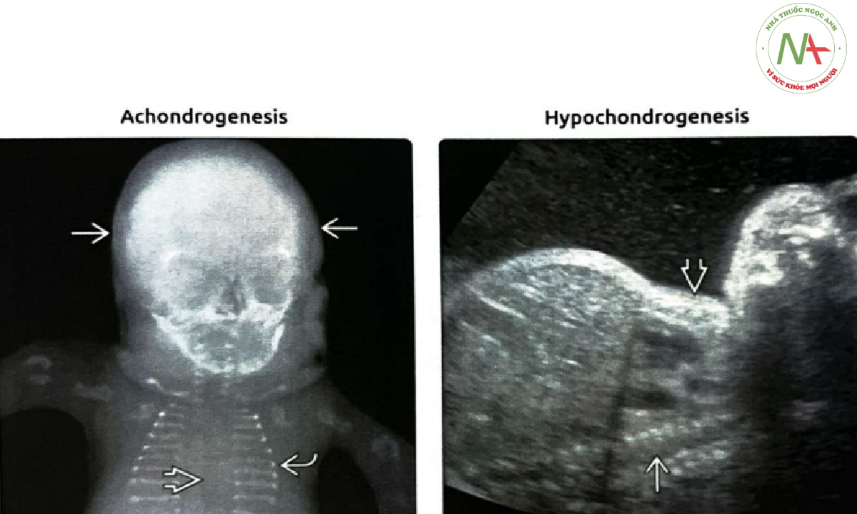 Phim X-quang của một thai nhi bị bất sản sụn (achondrogenesis) loại IA