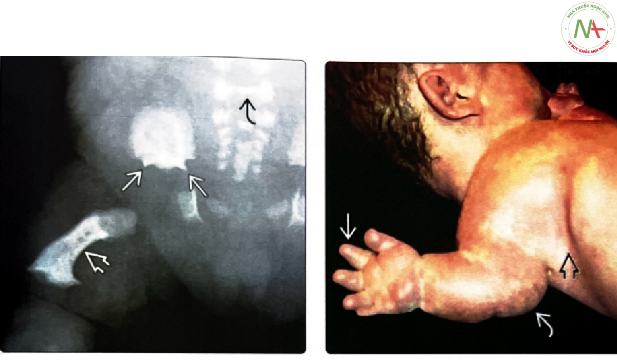 Phim X-quang của một trẻ sơ sinh chết lưu bị TD loại I
