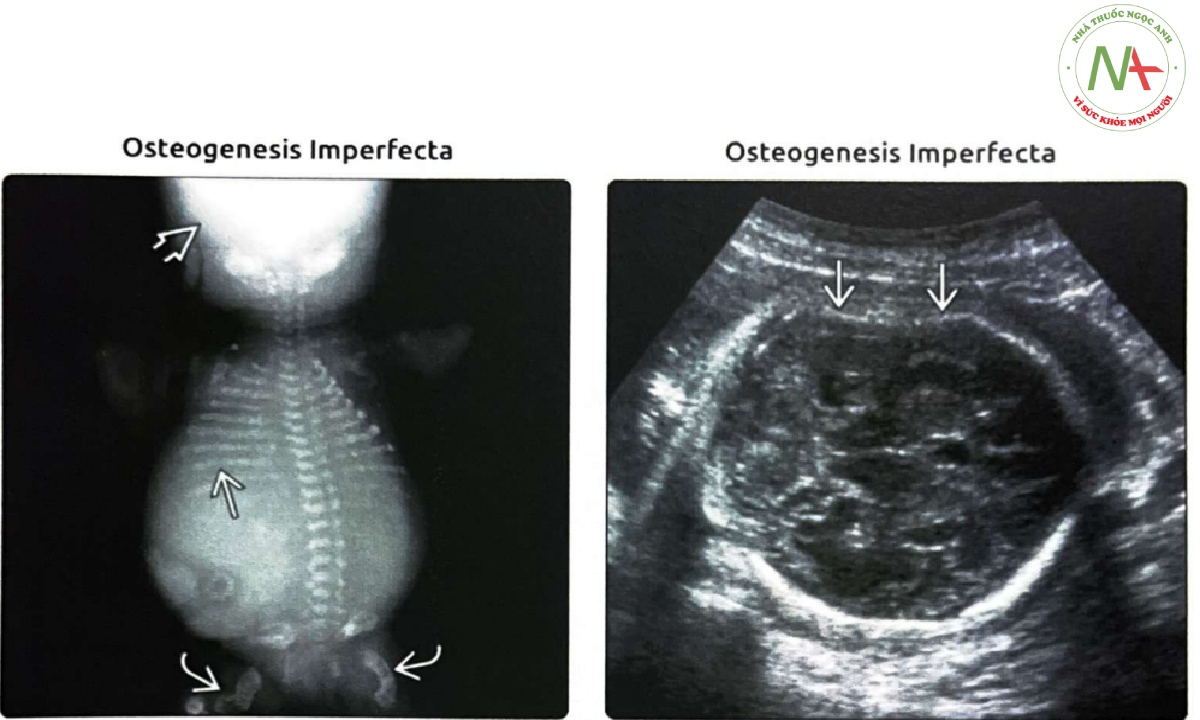 Phim X-quang của một trẻ sơ sinh chết lưu mắc bệnh tạo xương bất toàn (osteogenesis imperfecta) gây chết chu sinh