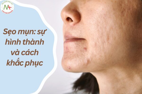 Tổng quan Sẹo mụn: sự hình thành và cách khắc phục