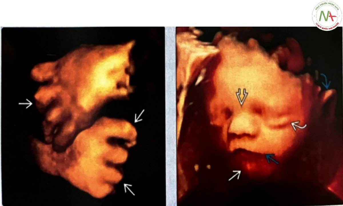 Siêu âm 3D bàn tay thai nhi trong quý 3 bị co cứng khớp xa (distal arthrogryposis)