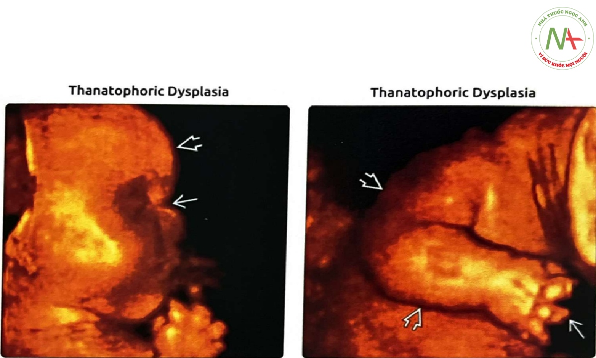 Siêu âm 3D một thai nhi ở quý 3 được xác định mắc loạn sản xương gây chết (thanatophoric dysplasia) loại I