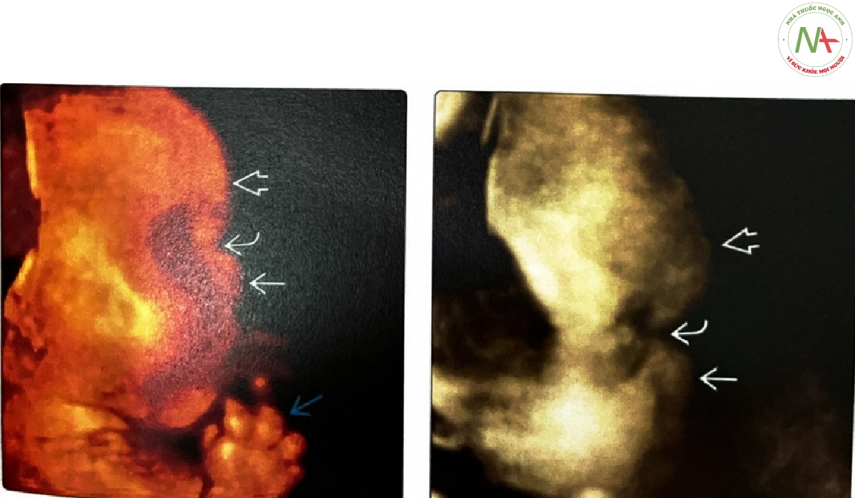 Siêu âm 3D trong quý 2 của một thai nhi cho thấy trán dô đáng kể, sống mũi lõm và chóp mũi ngắn hếch