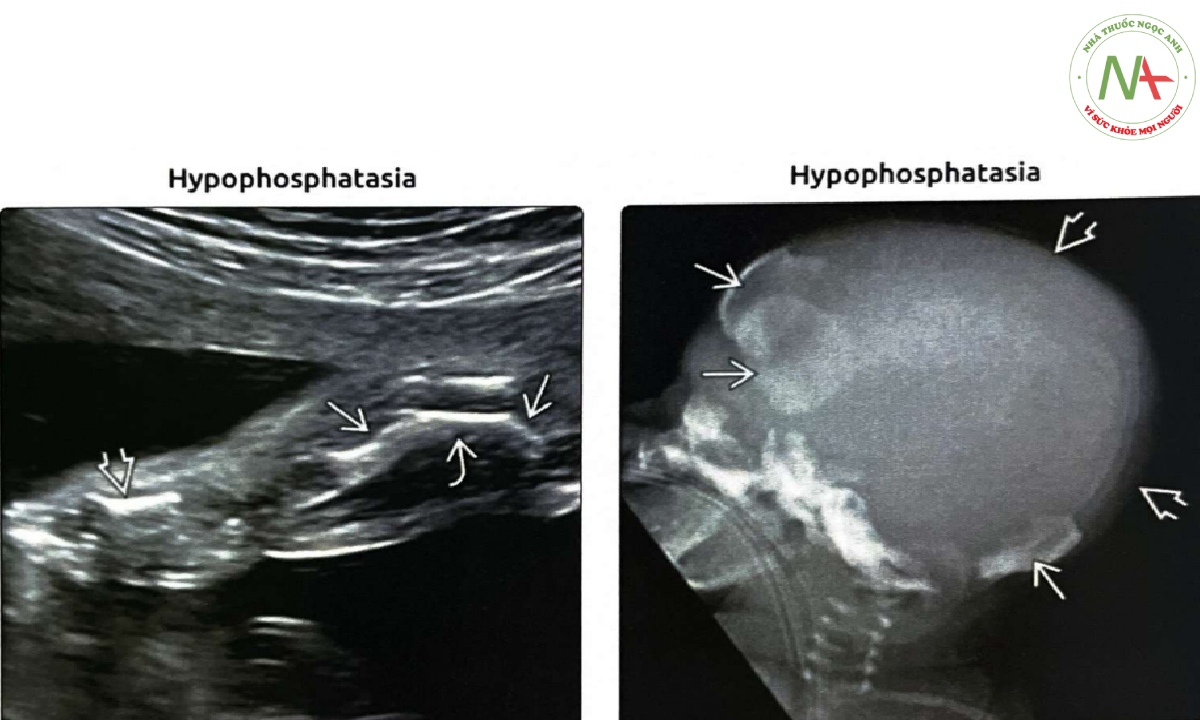 Siêu âm chi dưới thai nhi bị giảm phosphatase kiềm (hypophosphatasia) gây chết chu sinh trong quý 3