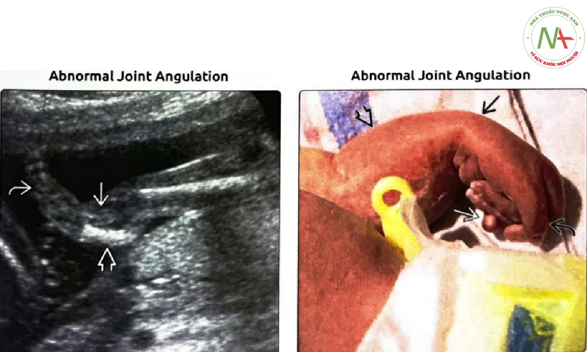 Siêu âm cho thấy một thai nhi bị bất sản xương trụ, thiểu sản xương quay cổ tay lệch về phía xương trụ cố định