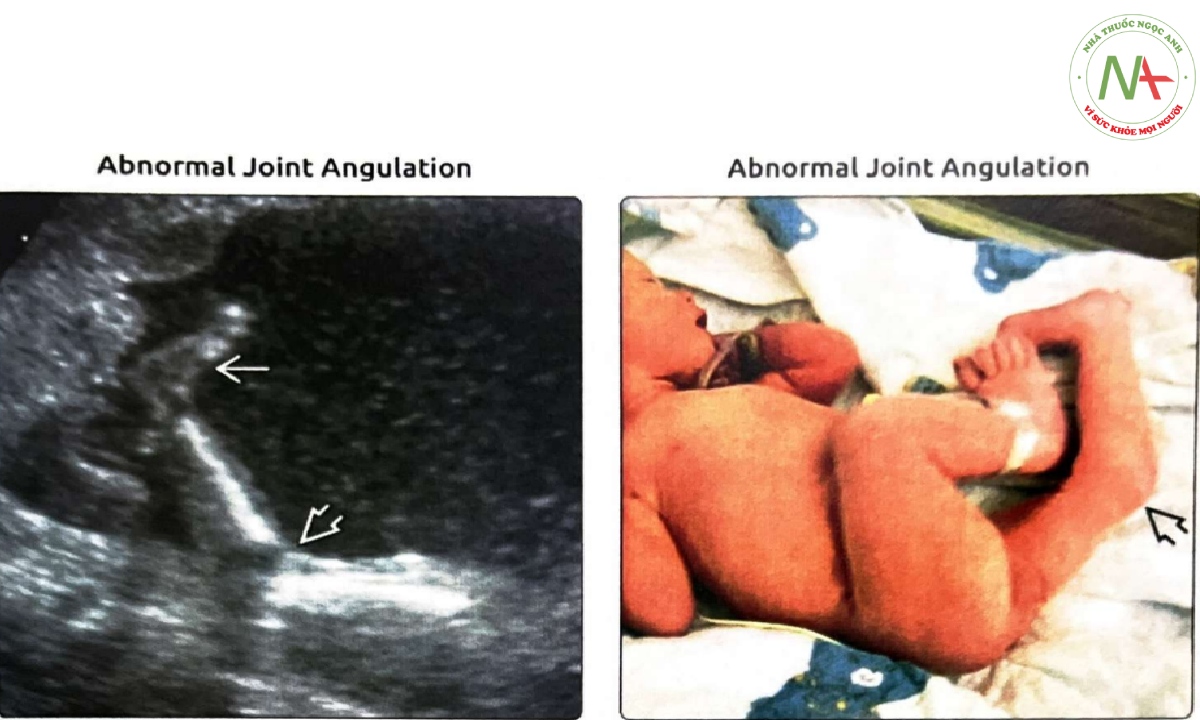 Siêu âm mặt cắt dọc cho thấy trật khớp gối bẩm sinh với cẳng chân duỗi quá mức (genu recurvatum)