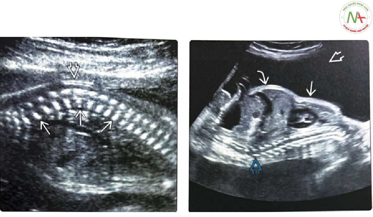 Siêu âm mặt cắt dọc của thai nhi bị TD trong quý 3 cho thấy đốt sống dẹt (platyspondyly) và cột sống ngực-thắt lưng gù