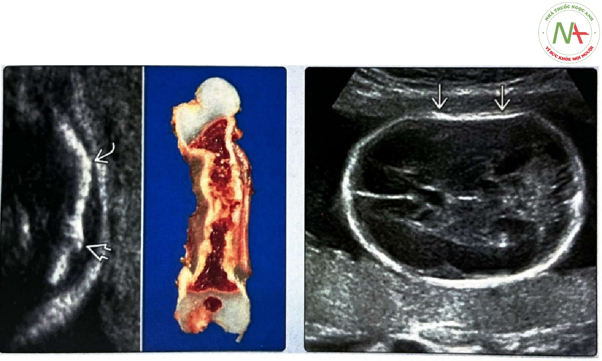 Siêu âm mặt cắt dọc xương đùi của thai nhi mắc bệnh tạo xương bất toàn