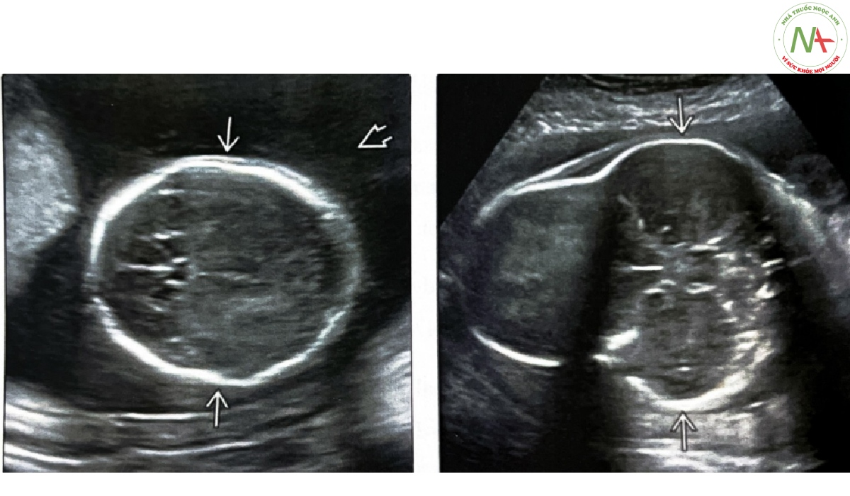 Siêu âm mặt cắt ngang ở thai nhi 29 tuần tuổi này cho thấy hình dạng hộp sọ bất thường