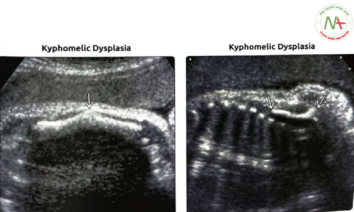 Siêu âm mặt cắt vành cho thấy xương đùi gập góc ở một thai nhi được chẩn đoán sau sinh bị loạn sản kyphomelic.