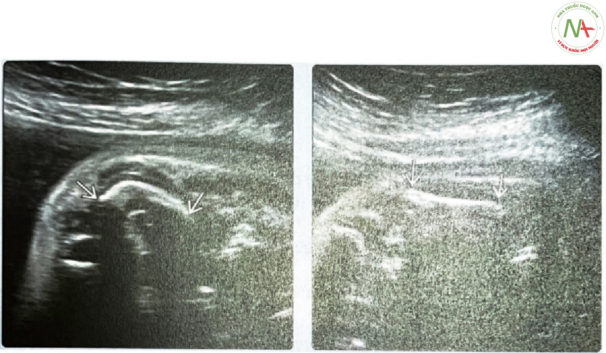 Siêu âm quý 2 thai nhi mắc TD loại I