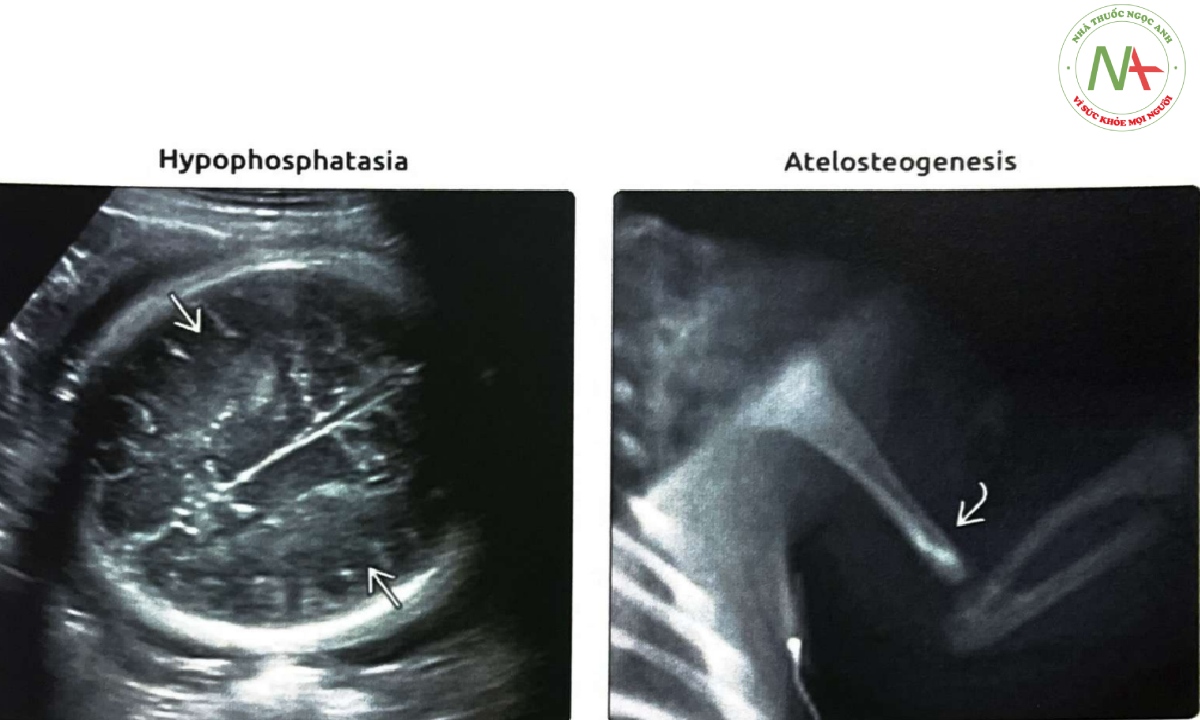 Siêu âm trong quý 3 của một thai nhi bị giảm phosphatase kiềm (hypophosphatasia) gây chết chu sinh