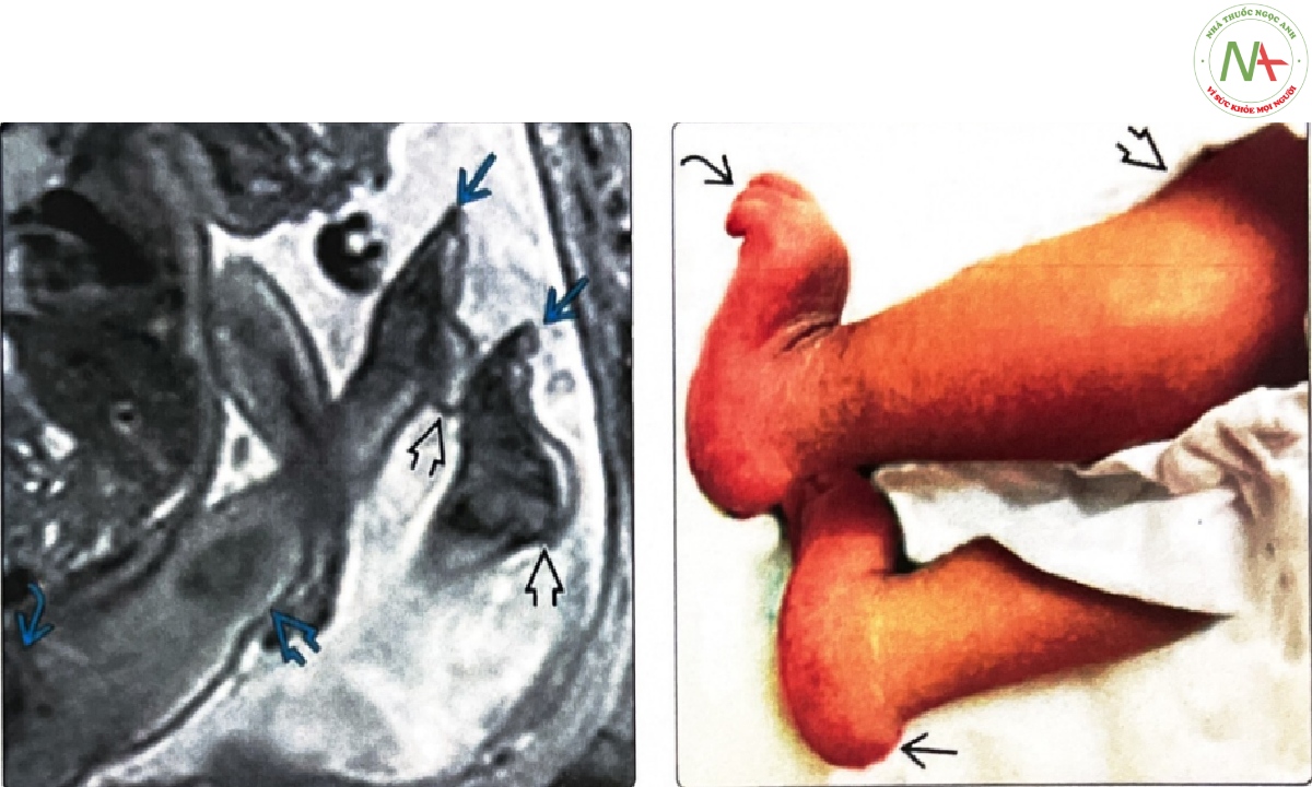 T2 MR mặt cắt dọc của một thai nhi bị co cứng khớp (arthrogryposis)