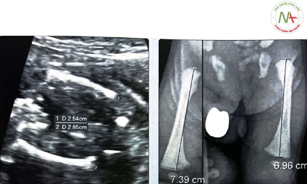 Thai nhi 19 tuần tuổi này bị loạn sản xương đùi khu trú đoạn gần