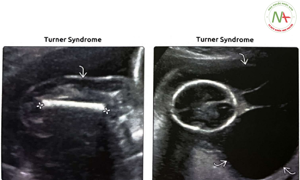 Thai nhi mắc hội chứng Turner này, FL (thước cặp) bị trễ 2 tuần khi thai được 20 tuần tuổi.