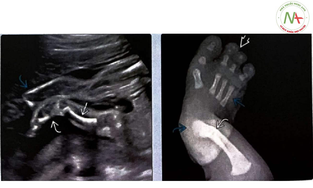 Thai nhi này bị bất sản đoạn xa xương mác (FH), chi dưới bên trái ngắn hơn chi dưới bên phải