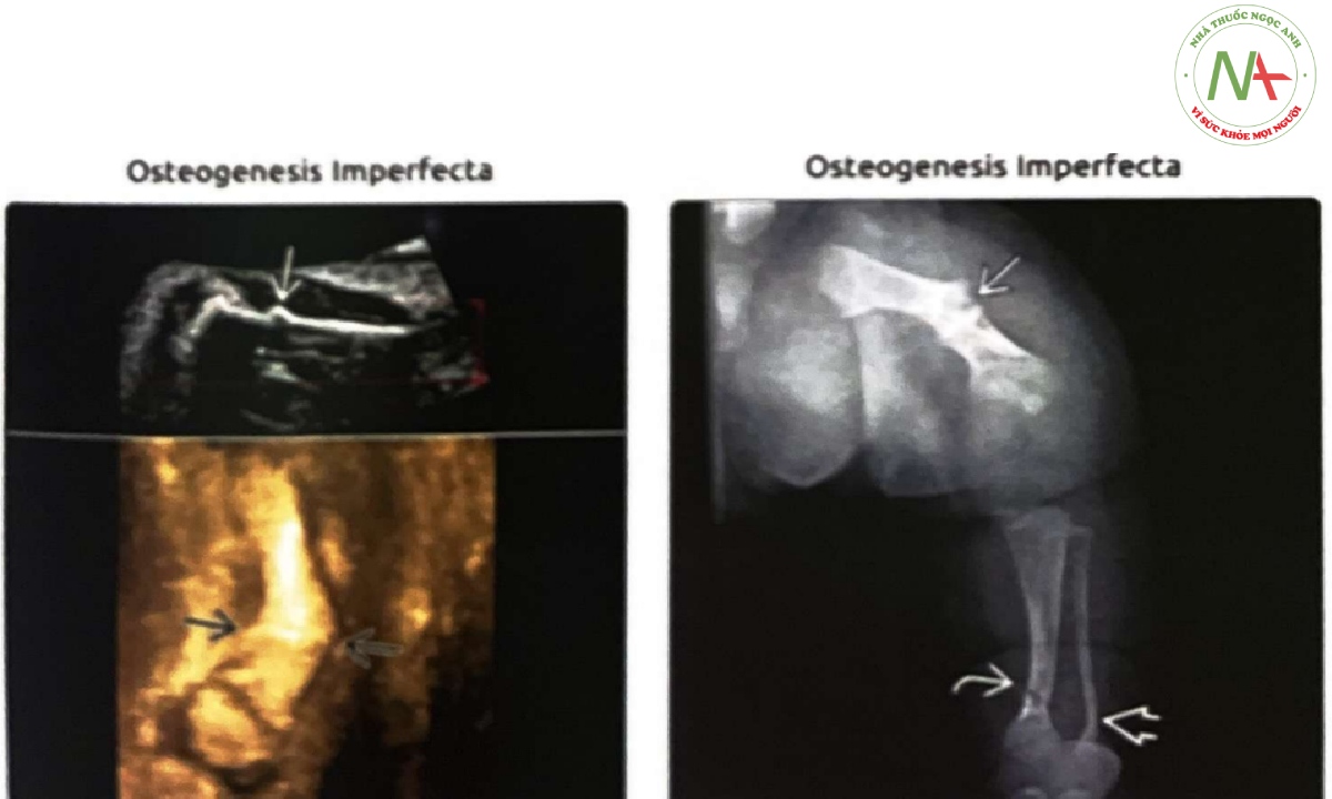 Thai nhi này có xương dài ngắn, thứ phát do bệnh tạo xương bất toàn (osteogenesis imperfecta-OI)