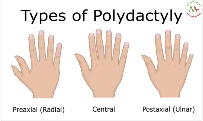 Thừa ngón (POLYDACTYLY)