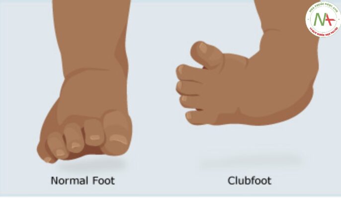 Tổng quan Bệnh chân khoèo (CLUBFOOT)