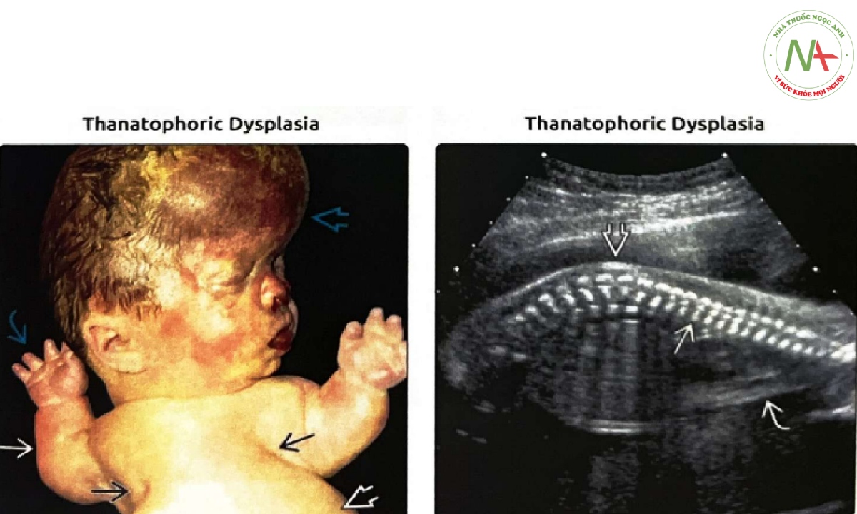 Trẻ sơ sinh chết lưu với các đặc điểm kiểu hình điển hình gặp trong loạn sản xương gây chết (thanatophoric dysplasia) loại II