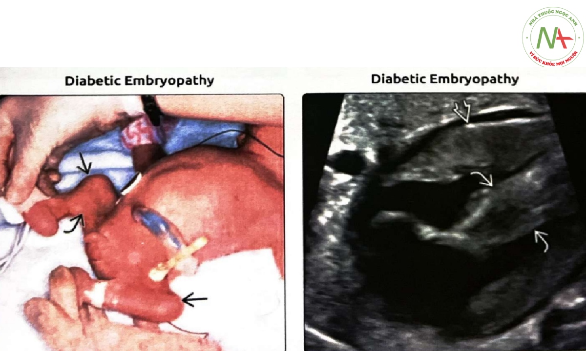 Trẻ sơ sinh này bị thoái triển phần đuôi liên quan đến bệnh lý phôi thai đái tháo đường do mẹ mắc bệnh đái tháo đường kiểm soát kém
