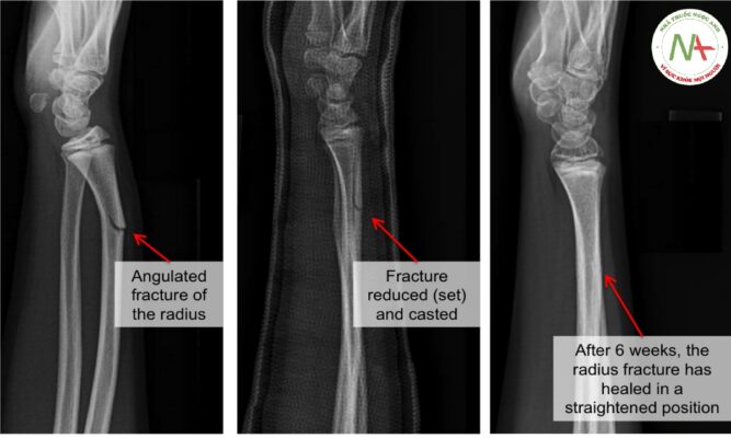 Xương cong/gập góc (CURVED/ANGULATED BONES)