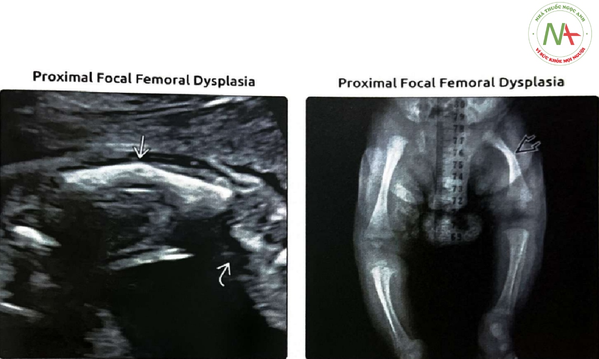Xương đùi ngắn, gập góc với mở góc vào trong ở đầu gối là một dấu hiệu điển hình của loạn sản xương đùi khu trú đoạn gần (PFFD)