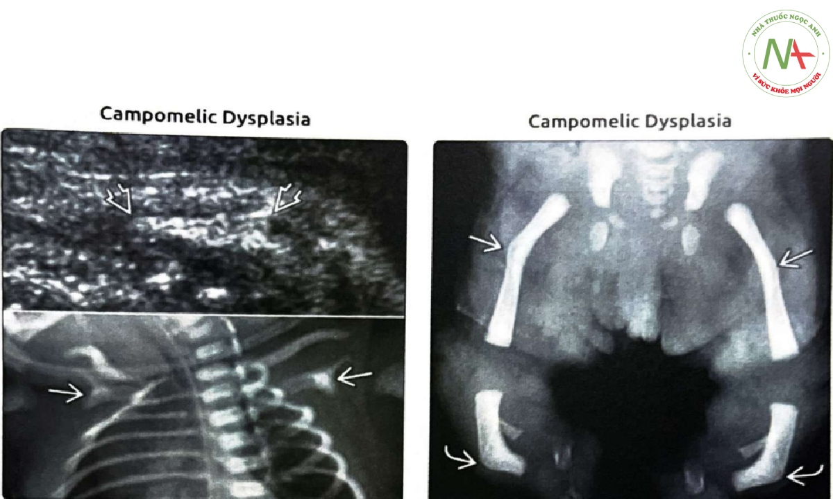 Xương vai luôn bất sản hoặc thiểu sản trong loạn sản chi cong (campomelic dysplasia).