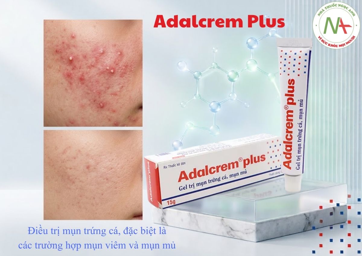 Adalcrem Plus 15g 3 Adalcrem Plus - Điều trị mụn trứng cá
